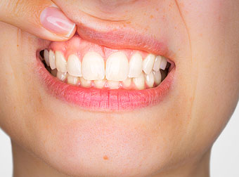 Gum Disease Treatment